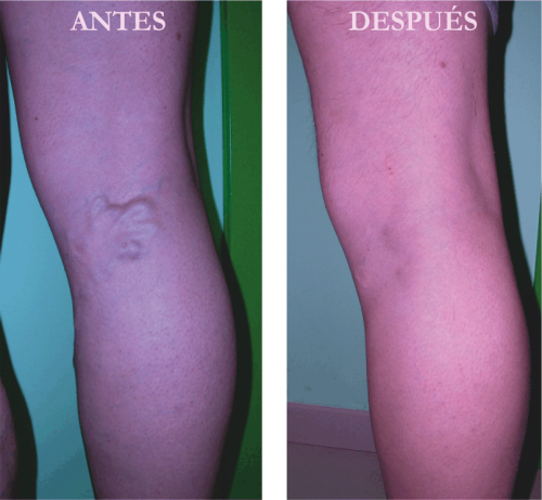 Foto Varices. Dr Oyola